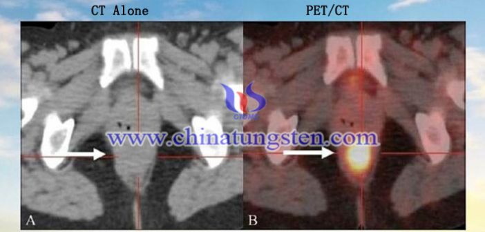 PET-CT ???? ??? ??? ?? ?????